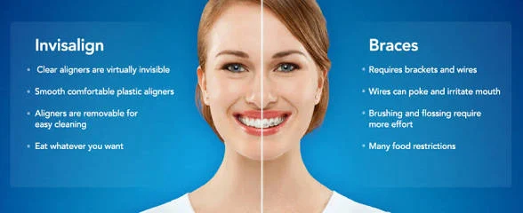 Illustration comparing clear aligners and fixed braces