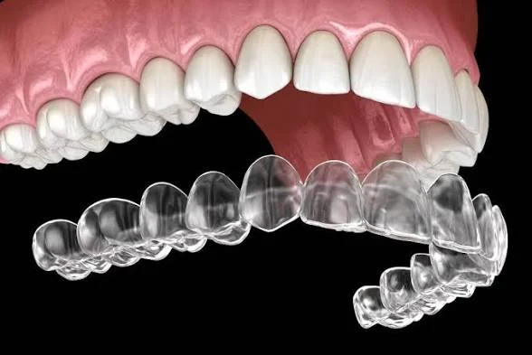 Clear upper and lower dental aligners shown beside a model of teeth